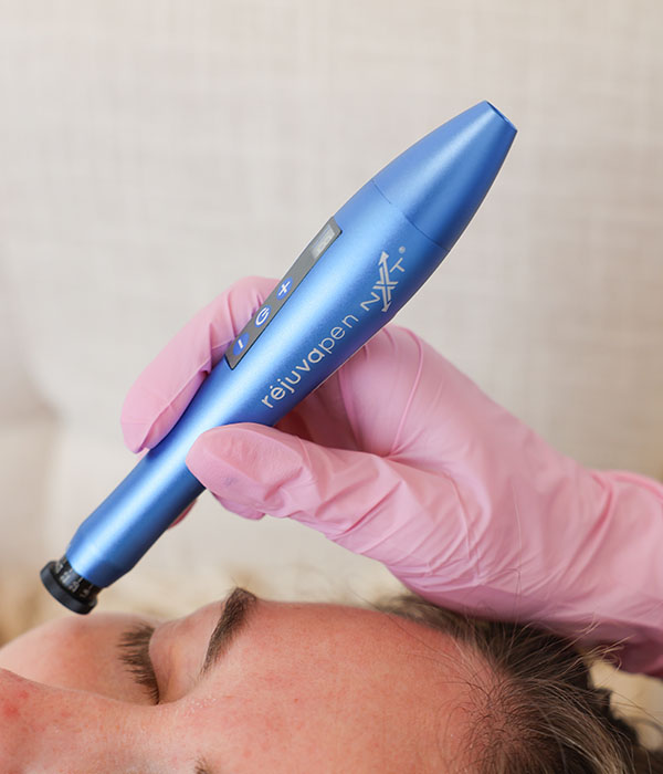 microneedling-img